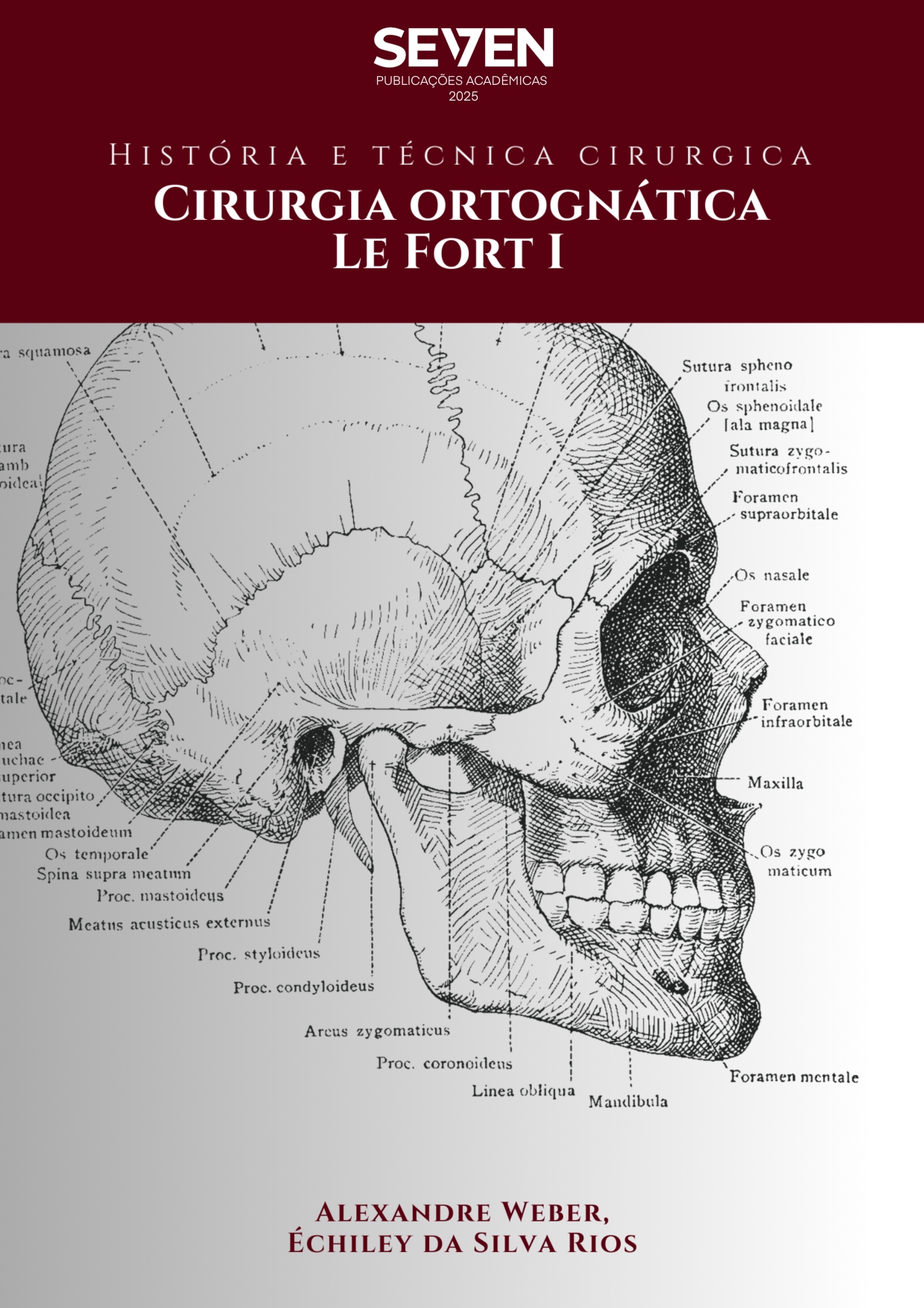 História e Técnica Cirúrgica – Cirurgia ortognática Le Fort I